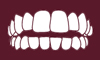 Crowded teeth