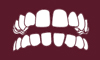 Gapped teeth