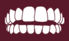 Open bite