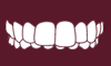 OVERBITE