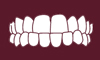 Underbite