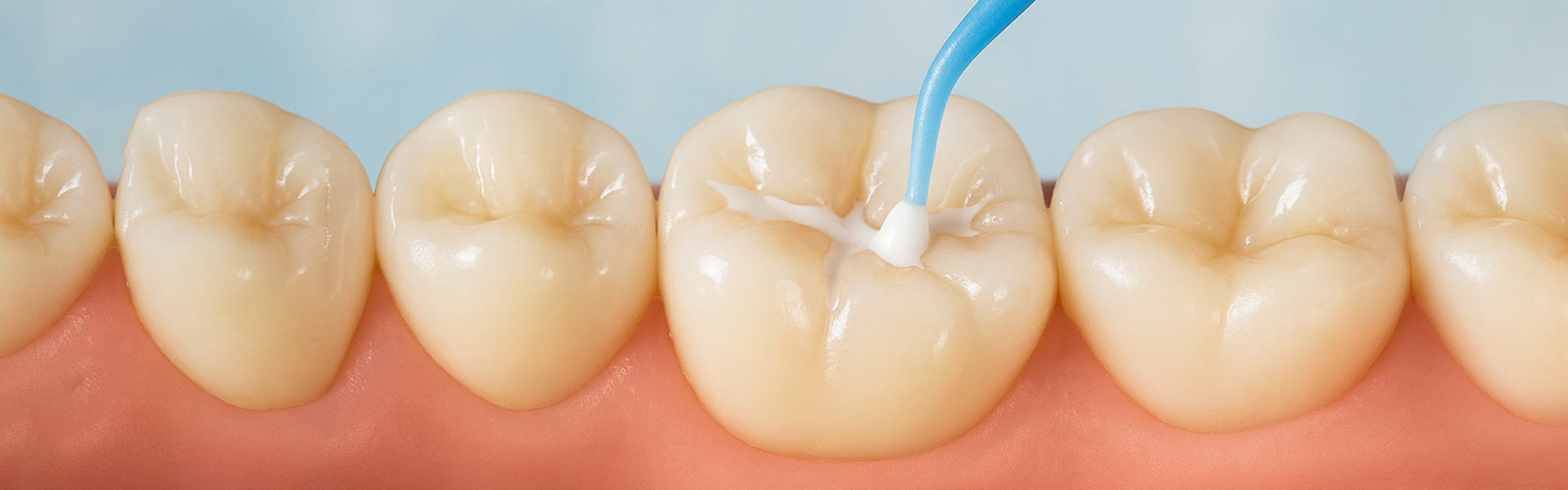 Can Dental Sealants Be Utilized On Front Teeth